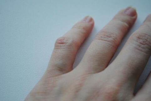 Arthritis lumps appear on the little finger. 