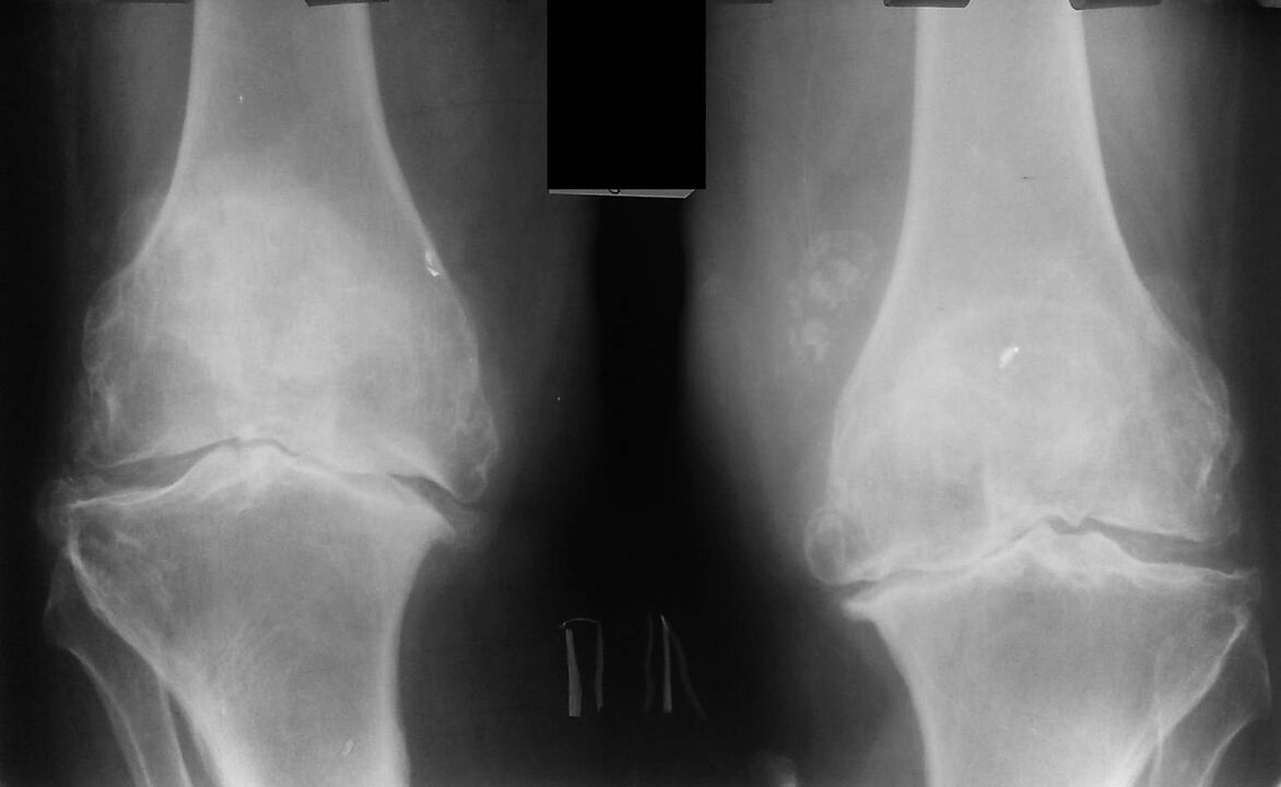 x-ray of the knee joint with arthrosis