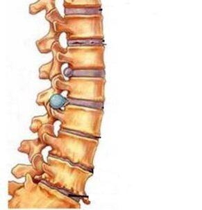How the cervical area osteochondrosis develops