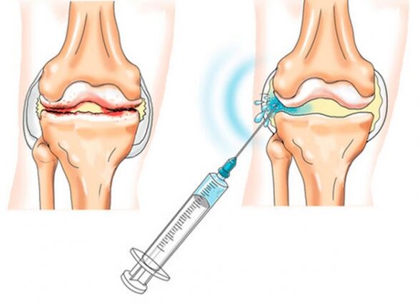 intra-articular injections for knee arthrosis