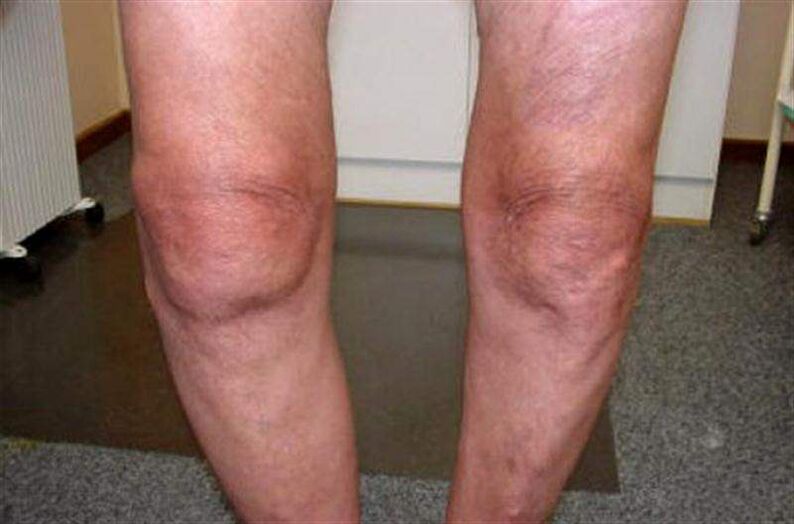 swollen knees due to arthritis