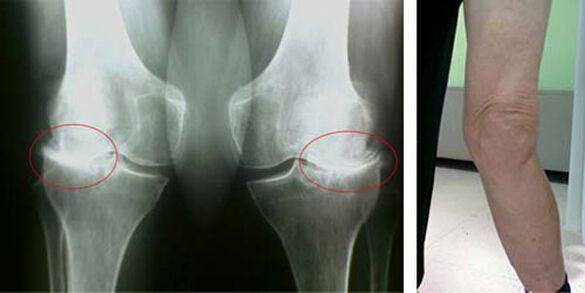 x-ray osteoarthritis of the knee