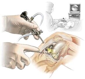 Explanation of Dash Drug Arthrosis Diagnosis