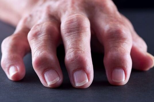 Finger articular defects due to arthrosis or arthritis